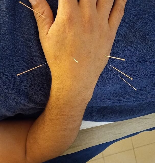 Alcoutim Acupuntura & Massagem / RS Acupuncture-Acupunturista